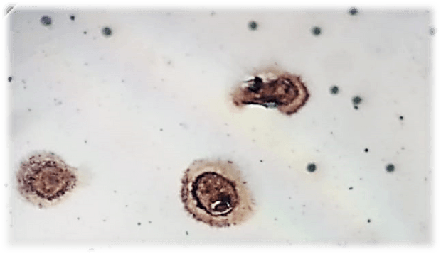 CAML. Позитивная реакция на EpCAM. Пациентка 54 лет. Рак яичников  III стадия.