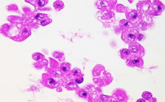 ΠΠ½ΡΡΠ°ΠΎΠΏΠ΅ΡΠ°ΡΠΈΠΎΠ½Π½ΡΠΉ ΡΠΎΡΠΊΠΎΠ± Ρ Π»Π΅Π³ΠΊΠΎΠ³ΠΎ, 5 Π΄Π΅Π½Ρ Π² Π’ΠΠ‘-1, cell-block