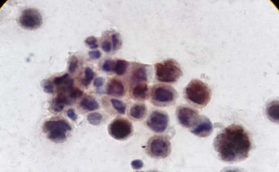 ΠΡΠ°Π΄ΠΎΠΊ Π°ΡΡΠΈΡΠΈΡΠ΅ΡΠΊΠΎΠΉ ΠΆΠΈΠ΄ΠΊΠΎΡΡΠΈ, ΠΠ¦Π₯ (WT1)