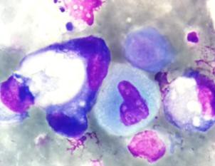 ΠΡΠΈΠ³ΠΎΡΠΎΠ²Π»Π΅Π½ΠΈΠ΅ ΡΠΈΡΠΎΠ»ΠΎΠ³ΠΈΡΠ΅ΡΠΊΠΈΡ
ΠΏΡΠ΅ΠΏΠ°ΡΠ°ΡΠΎΠ², ΠΏΡΠΎΠ²Π΅Π΄Π΅Π½ΠΈΠ΅ Π΄ΠΎΠΏΠΎΠ»Π½ΠΈΡΠ΅Π»ΡΠ½ΡΡ
ΠΈΡΡΠ»Π΅Π΄ΠΎΠ²Π°Π½ΠΈΠΉ (ΠΠ¦Π₯, Π€ΠΠ¦Π₯, ΠΠ¦Π , NGS, cell-block).