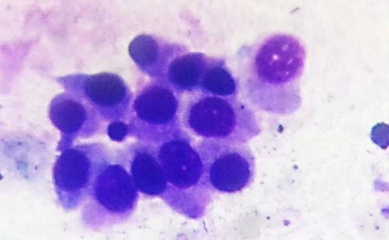 ΠΠ½ΡΡΠ°ΠΎΠΏΠ΅ΡΠ°ΡΠΈΠΎΠ½Π½ΡΠΉ ΡΠΎΡΠΊΠΎΠ± Ρ Π»Π΅Π³ΠΊΠΎΠ³ΠΎ, Π’ΠΠ‘-1, 7 Π΄Π΅Π½Ρ