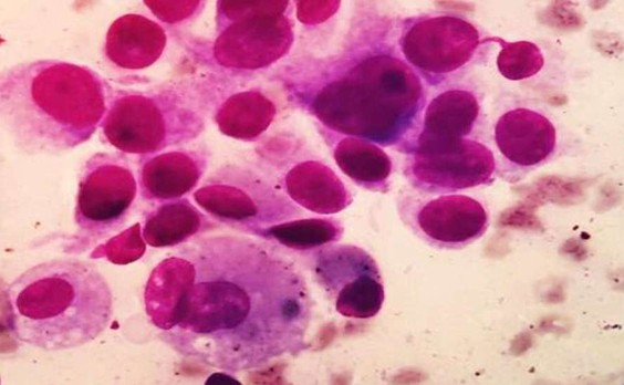 ΠΠ½ΡΡΠ°ΠΎΠΏΠ΅ΡΠ°ΡΠΈΠΎΠ½Π½ΡΠΉ ΡΠΎΡΠΊΠΎΠ± Ρ Π»Π΅Π³ΠΊΠΎΠ³ΠΎ, Π’ΠΠ‘-1, 5 Π΄Π΅Π½Ρ