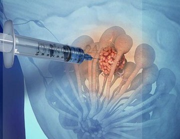 ΠΠΎΠ»ΡΡΠ΅Π½ΠΈΠ΅ ΠΌΠ°ΡΠ΅ΡΠΈΠ°Π»Π° ΠΏΡΠΈ ΡΠΎΠ½ΠΊΠΎΠΈΠ³ΠΎΠ»ΡΠ½ΠΎΠΉ Π°ΡΠΏΠΈΡΠ°ΡΠΈΠΎΠ½Π½ΠΎΠΉ Π±ΠΈΠΎΠΏΡΠΈΠΈ.