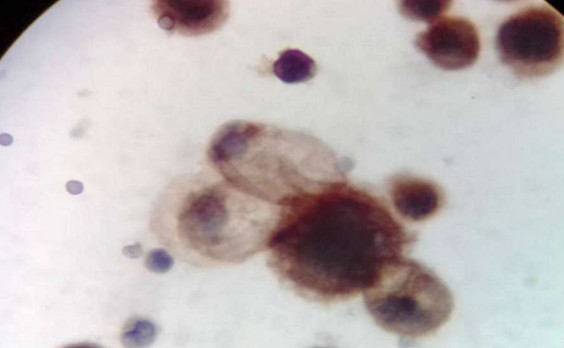 ΠΡΠ°Π΄ΠΎΠΊ Π°ΡΡΠΈΡΠΈΡΠ΅ΡΠΊΠΎΠΉ ΠΆΠΈΠ΄ΠΊΠΎΡΡΠΈ, ΠΠ¦Π₯ (CA125)