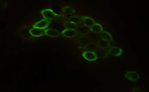 ΠΠ½ΡΡΠ°ΠΎΠΏΠ΅ΡΠ°ΡΠΈΠΎΠ½Π½ΡΠΉ ΡΠΎΡΠΊΠΎΠ± Ρ Π»Π΅Π³ΠΊΠΎΠ³ΠΎ, 5 Π΄Π΅Π½Ρ Π² Π’ΠΠ‘-1, Π€ΠΠ¦Π₯ (EpCAM/BerEP4), AlexaFluor-488